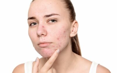 Come trattare le pelli acneiche in estate