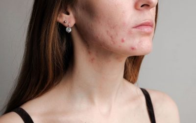 Acne e PCOS: come la pelle riflette il benessere ormonale