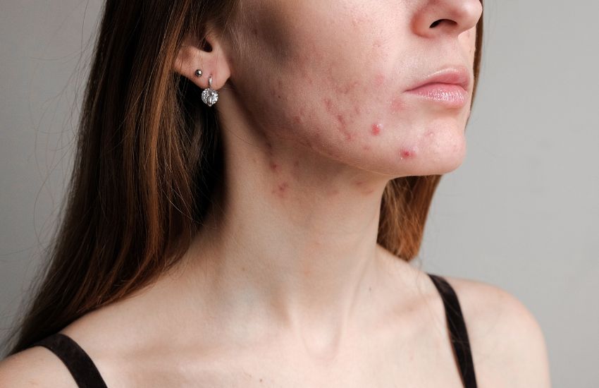 Acne e PCOS: come la pelle riflette il benessere ormonale