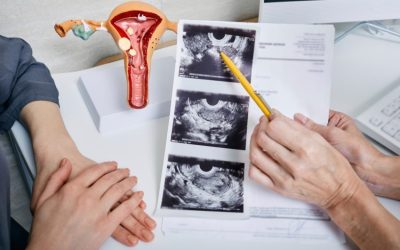 Trattamenti laser e a microonde: nuove frontiere nella gestione della PCOS?