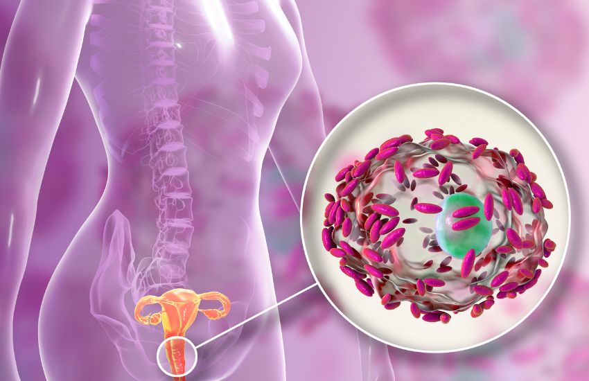 C’è una connessione tra PCOS e microbioma vaginale?